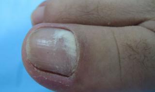 灰指甲早期症状图片